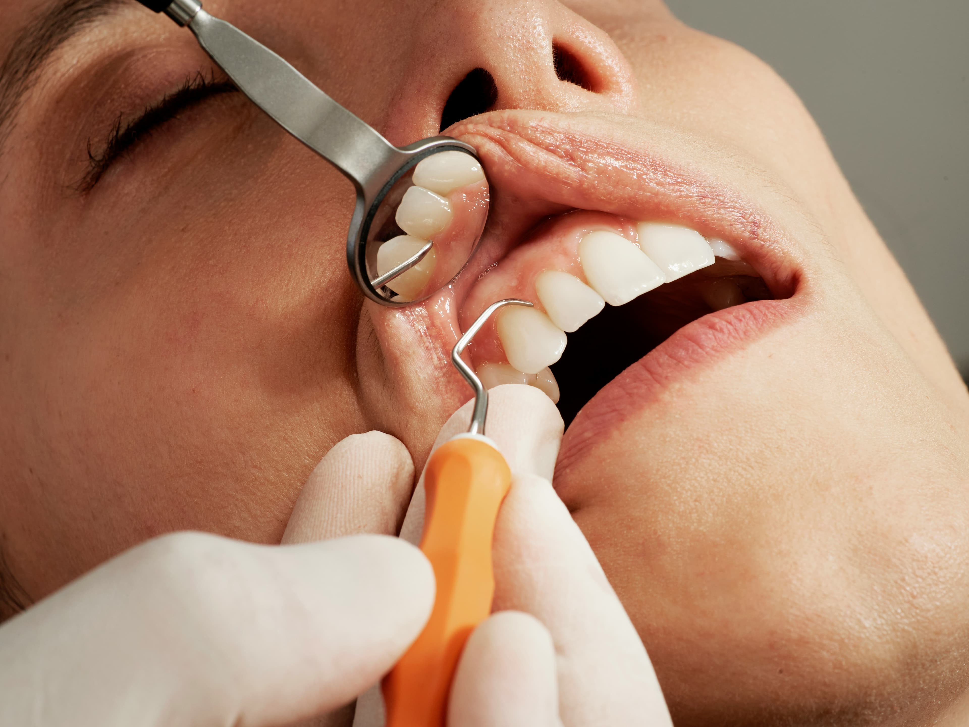 Cosmetic dentistry smile makeover at Grace Dental Care in Banasthali, Kathmandu