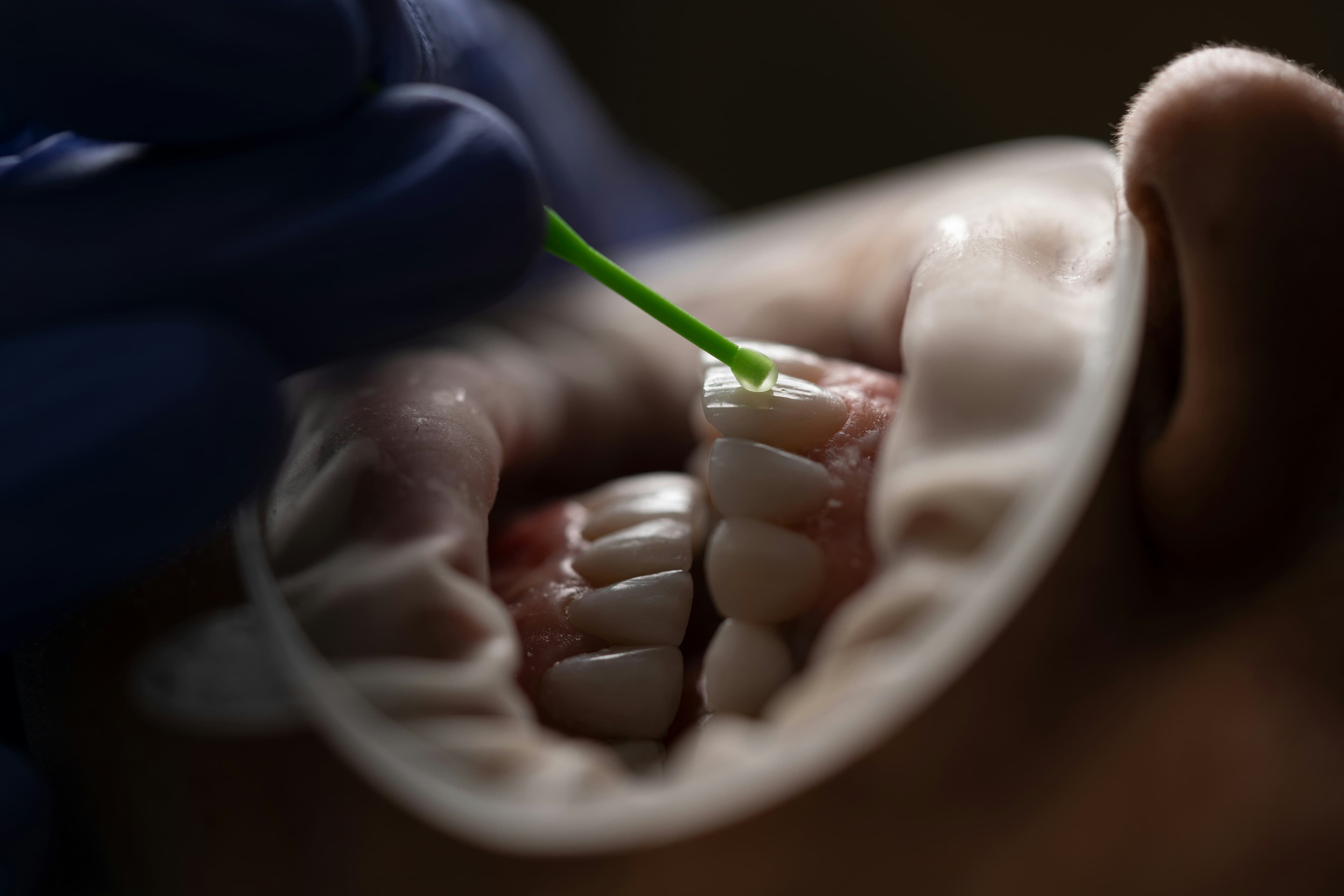 Dental crown and denture models at Grace Dental Care clinic in Banasthali, Kathmandu