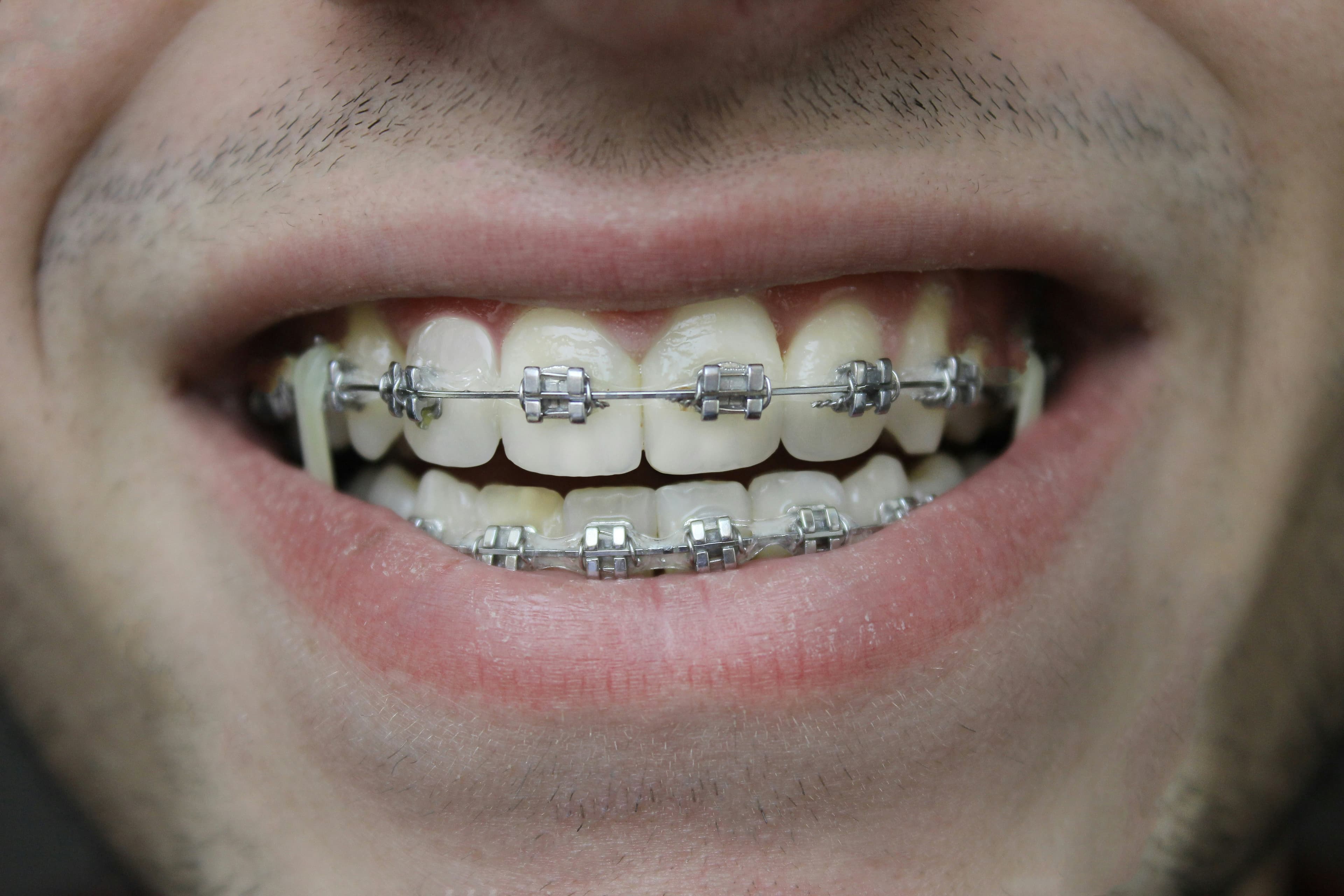 Orthodontic braces consultation at Grace Dental Care dental clinic in Kathmandu