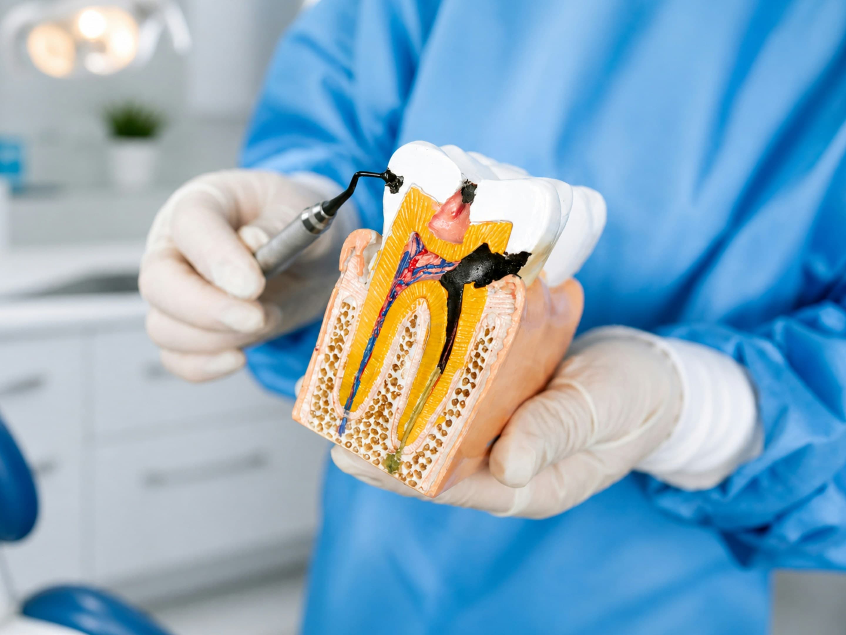 Root canal treatment at Grace Dental Care dental clinic in Banasthali, Kathmandu